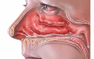 Болячки в носу, ранки: причины, чем лечить, что делать если не заживают