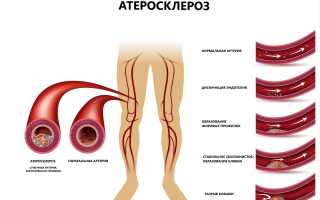 Что такое атеросклероз нижних конечностей и как его лечить?