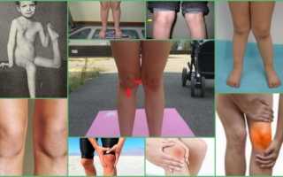 Дисплазия коленного сустава у детей и взрослых