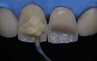 Сколы на зубах: почему откалываются зубы, что делать, способы лечения
