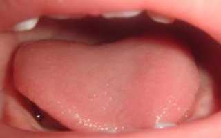 Пятна и налет на языке у детей и грудничков: виды, причины, диагноз и способы лечения
