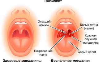 Лечение острого и хронического тонзиллита в домашних условиях народными средствами