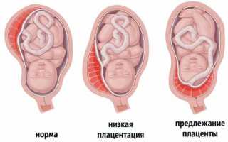 Чем грозит для плода низкое предлежание плаценты при беременности