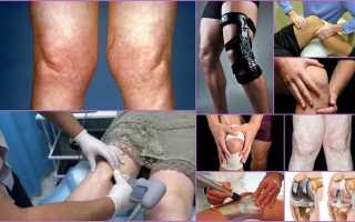 Гонартроз коленного сустава 3 и 4 степени — что это такое и как  лечить?