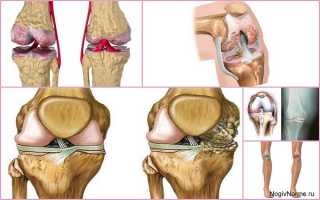 Гонартроз коленного сустава 2 степени — что это такое и как его лечить?