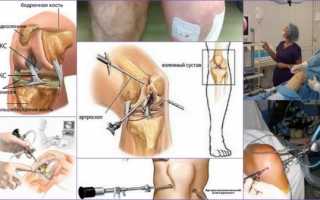 Что такое артроскопия коленного сустава как она проводится?