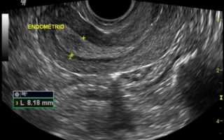 УЗИ органов малого таза у женщин: показания, подготовка, виды, понятная расшифровка
