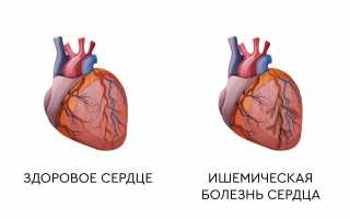 ИБС при беременности