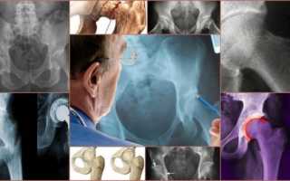 Симптоматика и лечение остеопороза тазобедренного сустава
