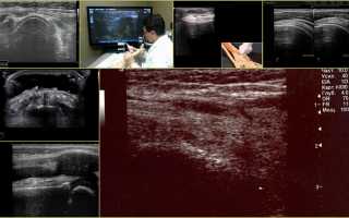 Что показывает УЗИ голеностопного сустава?