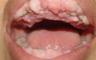 Рак полости рта: причины, симптомы, лечение и прогнозы при раке щеки, неба, языка, десны, дна полости рта