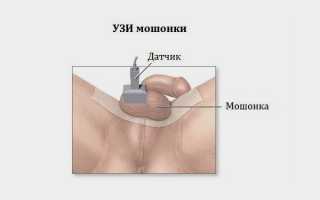 Как и зачем делают УЗИ органов мошонки: подготовка, проведение, результаты