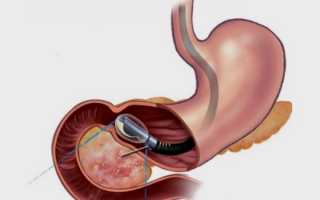 Как делается эндоУЗИ желудка (эндоскопическое исследование): подготовка, показания, расшифровка
