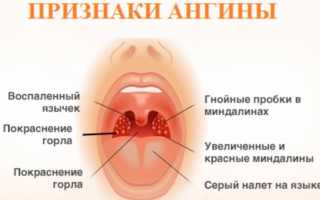 Белые точки на гландах и миндалинах в горле у детей и взрослых: причины и лечение