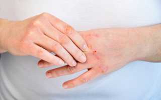 Токсический дерматит  у взрослых и детей —  лечение, причины, симптомы