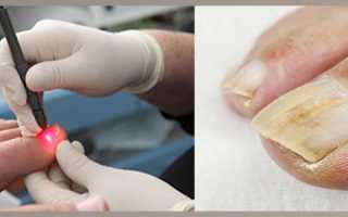 Лечение и удаление грибка ногтей лазером