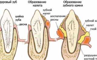 Зубной камень: что это такое, причины, как бороться