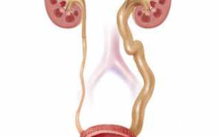Причины расширения мочеточника у ребенка: диагностика и лечение