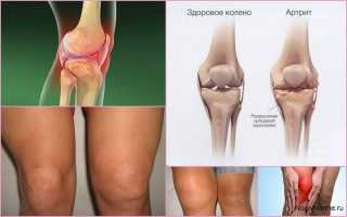 Что такое артрит коленного сустава — чем и как его лечить?