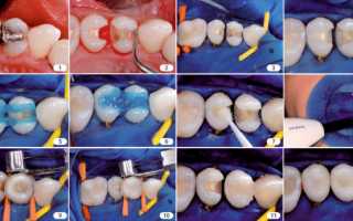 Световая пломба для зубов: что это, плюсы и минусы, этапы установки, срок службы