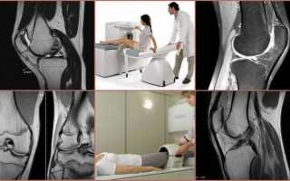 Что лучше: УЗИ, МРТ или рентгенография коленного сустава?