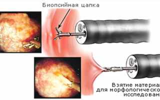 Для чего назначается и какие результаты дает ФГДС с биопсией — подготовка и последствия процедуры