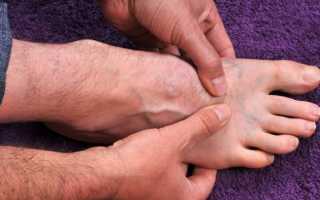 Причины и лечение онемения кожи на ноге