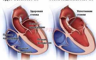 Из-за чего может произойти уплотнение аорты?