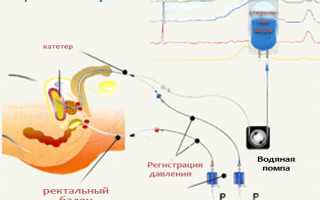 Что такое цистометрия: как проводится, критерии оценивания