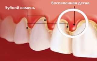 Ополаскиватели для полости рта: как выбрать, состав, рейтинг лучших зубных ополаскивателей