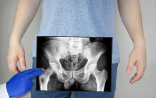Что показывает рентген тазобедренных суставов?