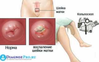 Особенности расширенной кольпоскопии — как проводится и ее результаты