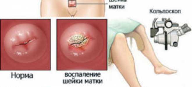 Особенности расширенной кольпоскопии — как проводится и ее результаты