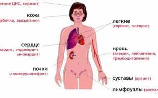 Совместимы ли системная красная волчанка и беременность