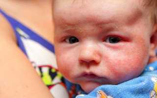 Аллергический дерматит в детском возрасте