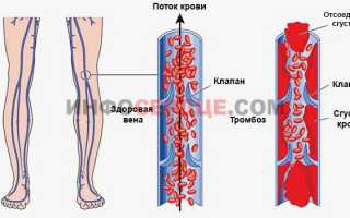 Что лучше — Тромбоасс или Кардиомагнил?