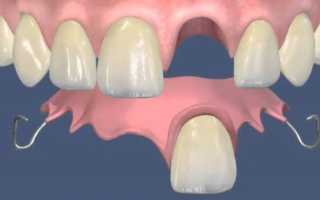 Съемные зубные протезы: что это, виды, материалы, как носить