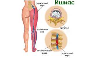 Как побороть ишиас при беременности