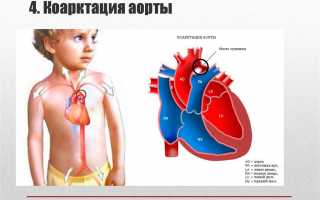 Насколько опасна коарктация аорты и как ее лечат?