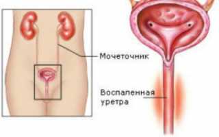 Уретрит у женщин – основные причины, проявления и лечение