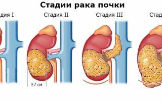 Прогноз выживаемости человека на разных стадиях рака почки