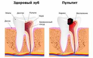 Признаки, симптомы и лечение пульпита зуба