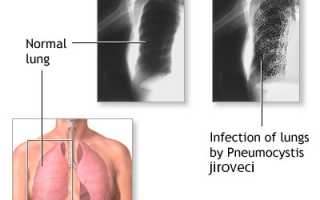 Пневмоцистная пневмония: этиология, клиника, диагностика, лечение