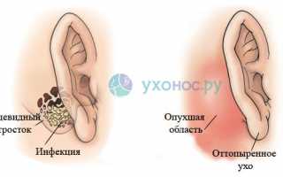 Мастоидит: причины, признаки, диагностика, как лечить, профилактика