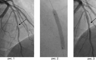 Стентирование сосудов сердца