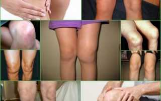 Что такое артроз и артрит коленного сустава, чем и как их лечить?