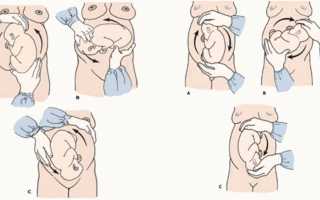 Наружный акушерский поворот плода при тазовом предлежании