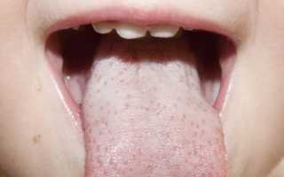 Белый налет на языке у ребенка: причины и методы лечения