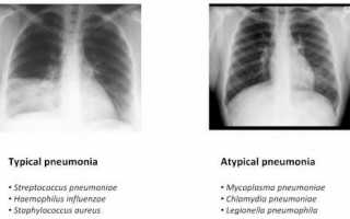 Атипичная пневмония: формы, симптомы и признаки, диагностика, лечение