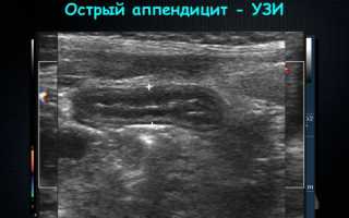 Видно ли на УЗИ аппендицит: как отличается диагностика у взрослых, детей и при беременности